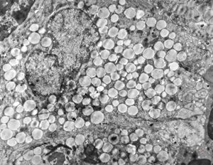 M,54y. | duodenum … Whipple disease, foamy histiocyte